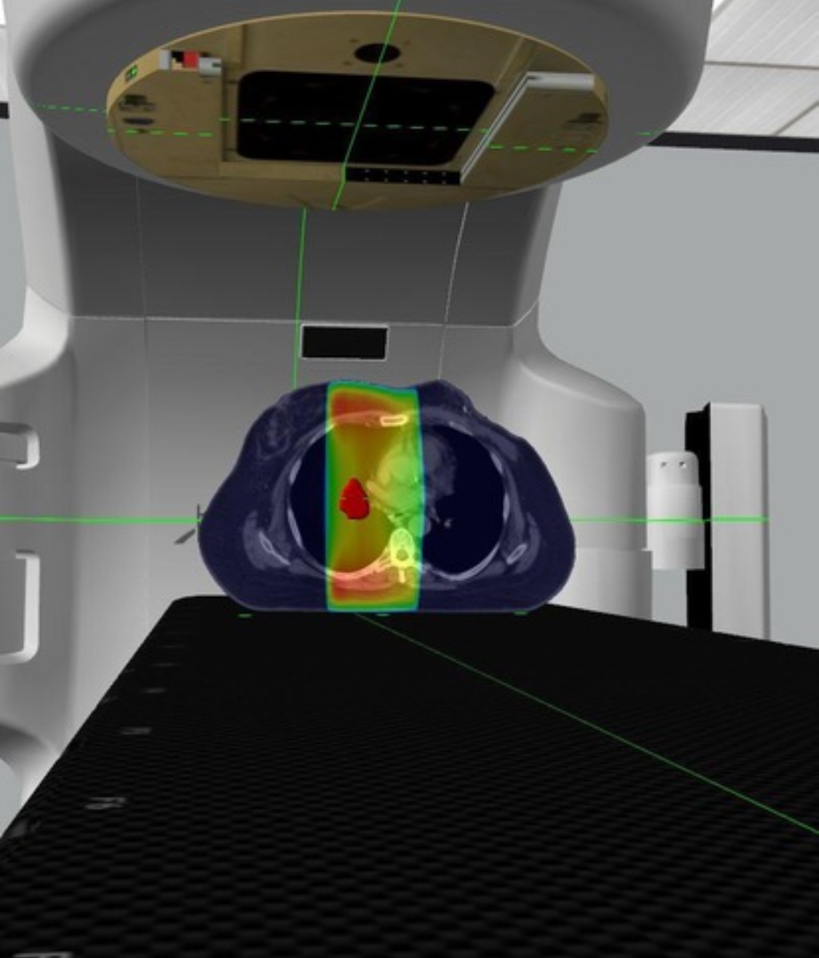 <p>tangents on;y, or 3 field setup which includes tangents plus sclav (supraclavicular fields), or a 4 field setup which adds a posterior axillary boost (PAB)</p>