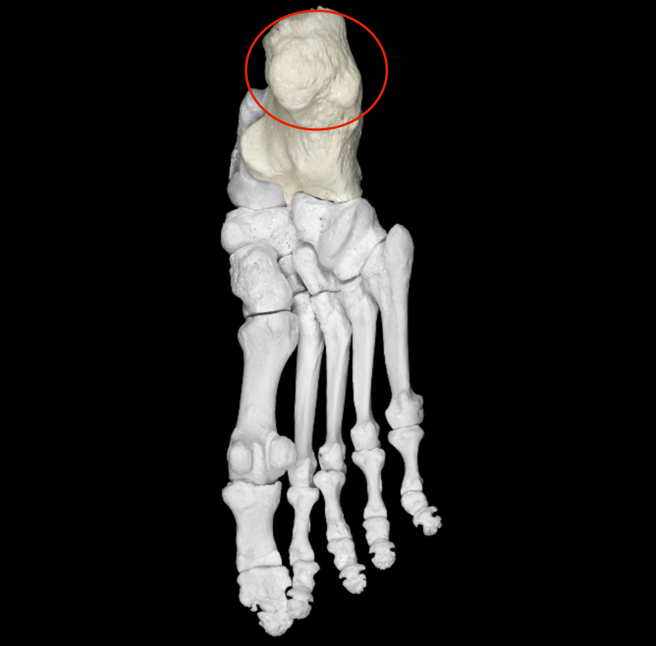 <p>posterior/inferior bump on calcaneus </p>