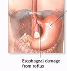 <p>acid from the stomach refluxes up into the oesophagus where there is no protective barrier so heartburn is felt which is due to acid irritating the surface, </p>