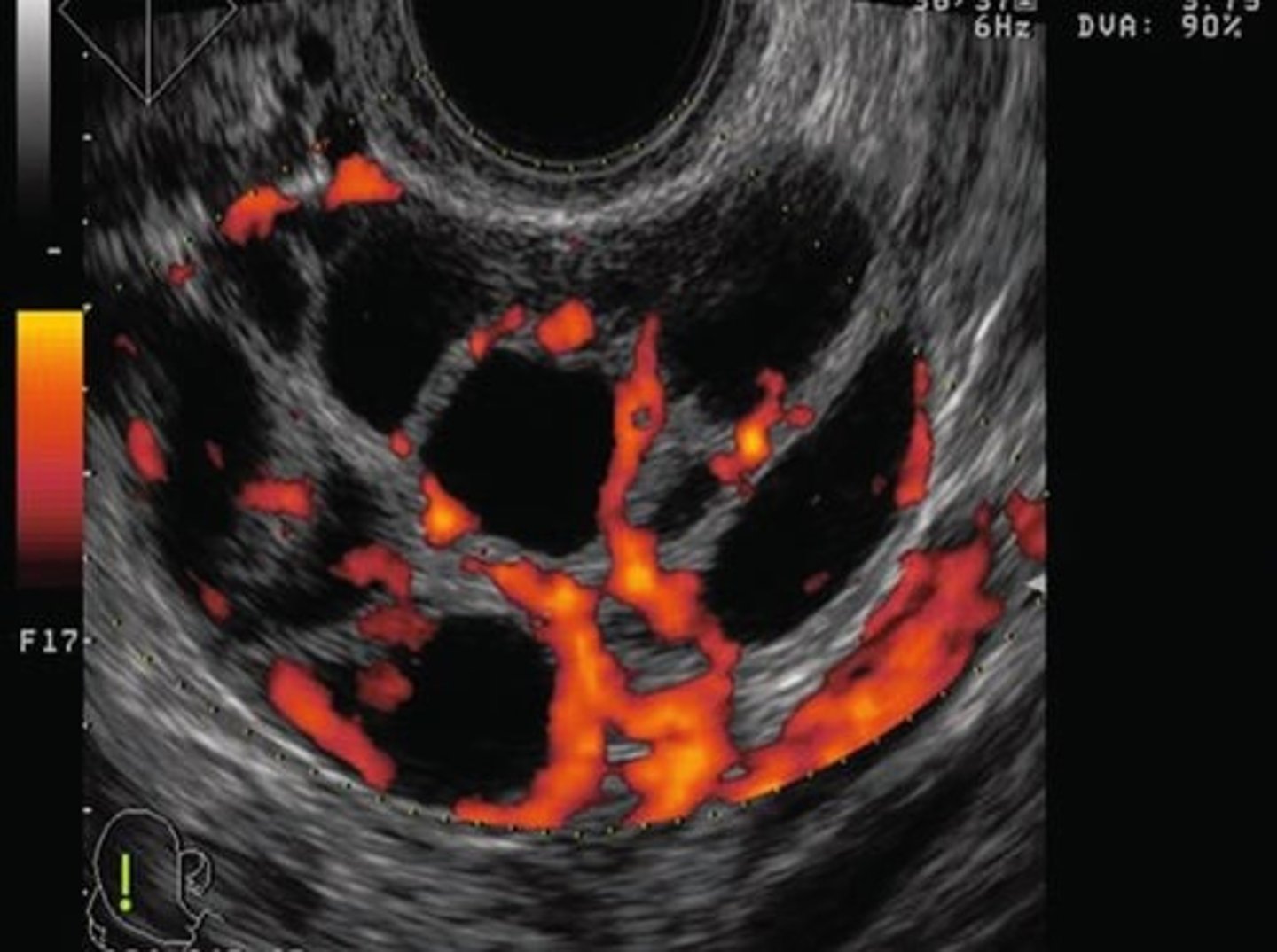 <p>ovarian hyperstimulation syndrome (OHS)</p>