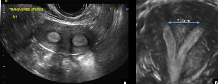<p>what uterine anomaly is this?</p>