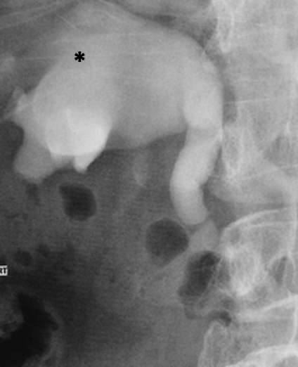 <p>What pathology is indicated at the asterisk?</p>