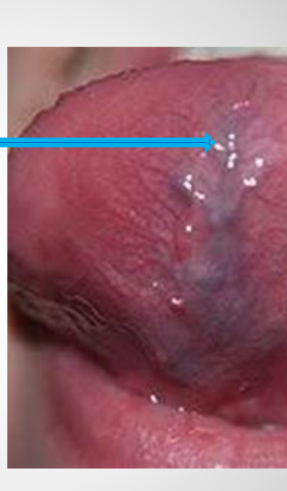 <p><span>It is mostly seen at the undersurface of the tongue</span></p><p><span>Means dilation of the veins</span></p><p><span>Varices: plural – is an abnormal dilated vessel with a tortuous course</span></p>