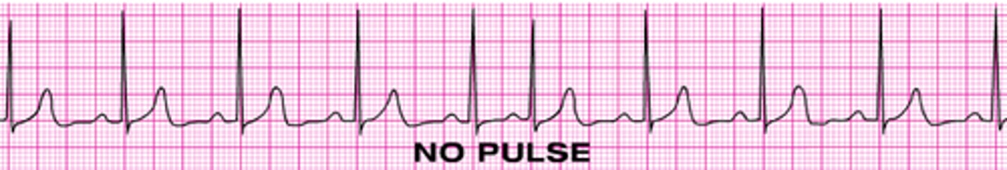<p>patient has a rhythm but NO PULSE, heart muscle loses its ability to contract even though the electrical activity is preserved. This is treated like asystole.</p>