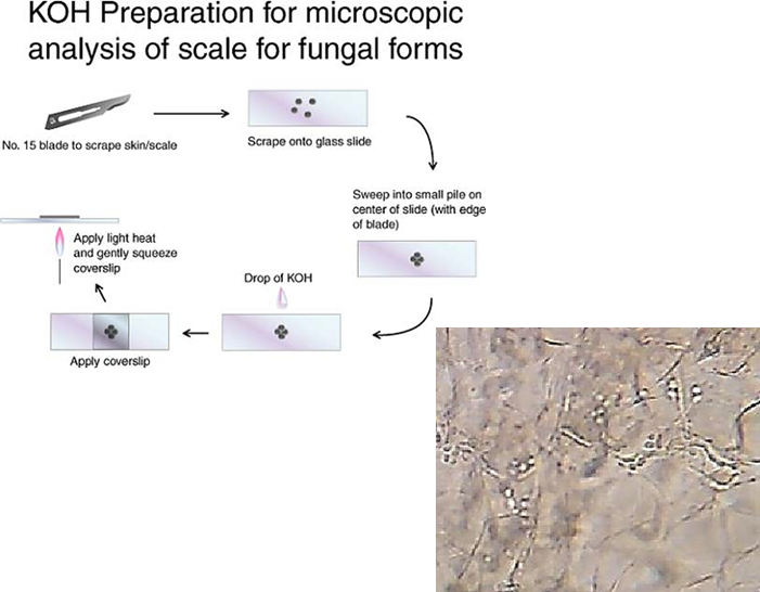 <ul><li><p class="">A skin scraping is taken, usually from the <strong>inner edge of a lesion</strong>.</p></li><li><p class="">The sample is placed on a <strong>glass slide</strong>.</p></li><li><p class="">A drop of <strong>potassium hydroxide </strong>is added to <strong>break down keratin</strong> and <strong>lyse other cells</strong>.</p></li><li><p class="">This process leaves <strong>only fungal elements</strong> visible, making it easier to identify fungi under a microscope.</p></li></ul><p></p>