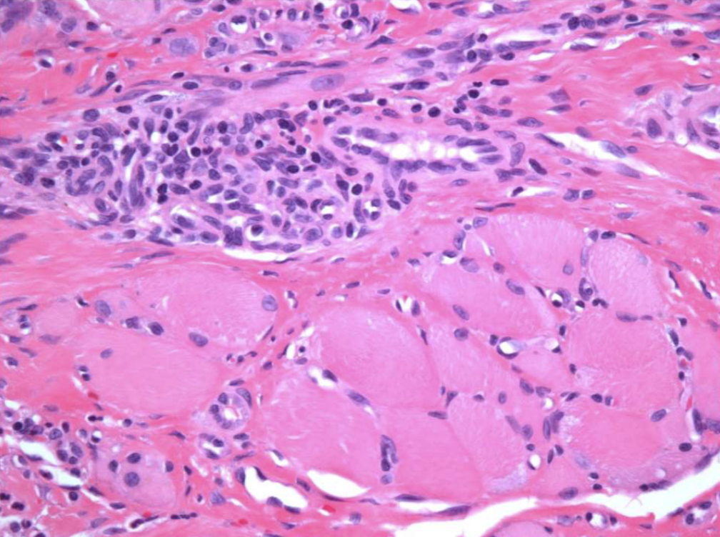 <ol><li><p>numerous eosinophils&nbsp;</p></li><li><p>inflammation of skeletal muscle&nbsp;</p></li><li><p>granulation tissue&nbsp;</p></li></ol><p></p>