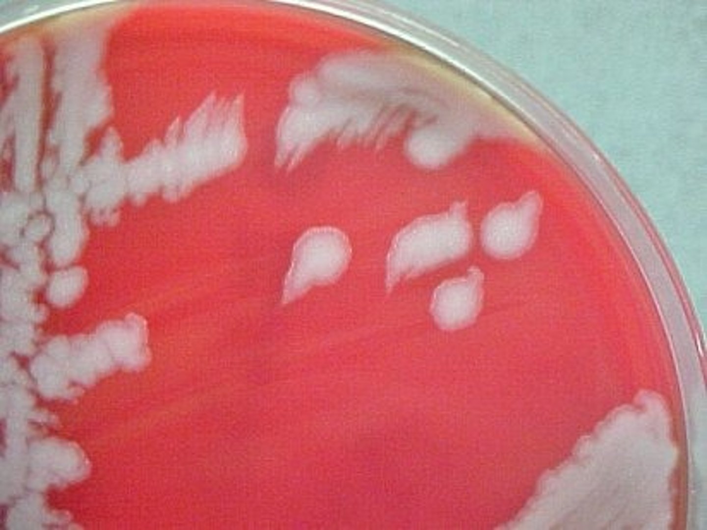 <p>- Raised</p><p>- Large</p><p>- Gray/white</p><p>- Irregular</p><p>- Beaten egg white look</p>