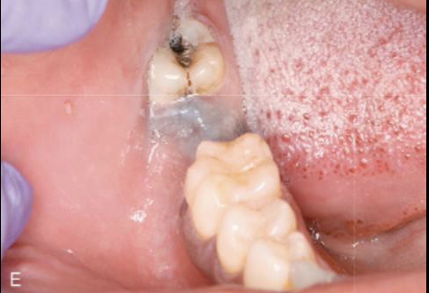 <p>What type of pigmented lesion?</p>