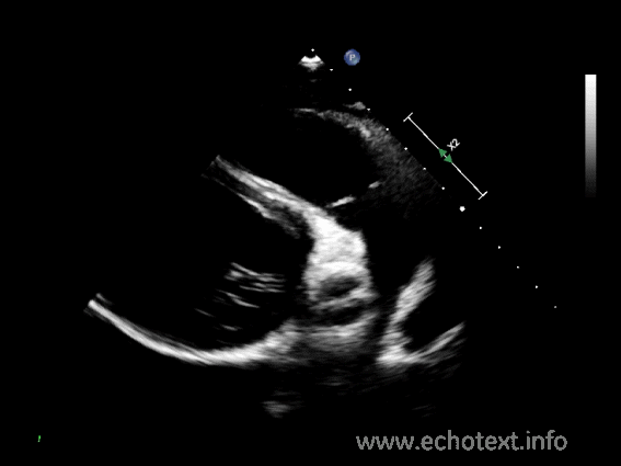 <p>What can be evaluated using color Doppler in the RVOT view?</p>