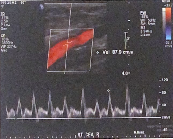 <p>This image was recorded proximal to an AVF. Describe how the arterial waveform is affected because of the finding distally.</p>