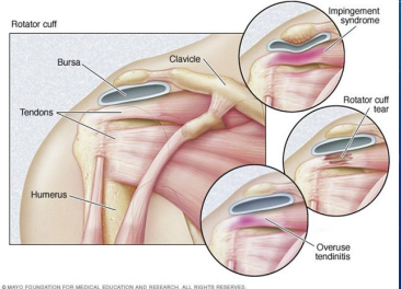 <p><strong>Impingement Syndrome: Diagnosis and Treatment </strong></p><p>-Diagnosis:</p><ul><li><p>Clinical</p></li><li><p>___ to r/o RTC tear if highly suspicious or not improving with treatment </p></li></ul><p>-Treatment:</p><ul><li><p>Rest, ice, ________</p></li><li><p>PT, steroid injection</p></li><li><p>Surgery should be considered if the patient has not improved after _-__ weeks </p></li></ul><p></p>