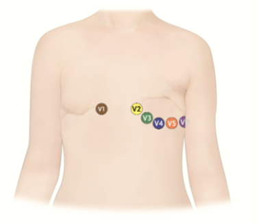 <ul><li><p>Avoid placing electrodes on scar tissue, which can be fragile and may be injured when the electrode is removed</p></li><li><p>Electrodes should be placed as close as possible to the standard locations</p></li></ul><p></p>
