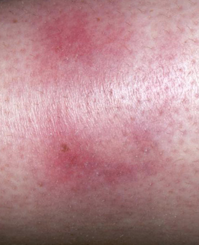 <ul><li><p>prodrome: fever, fatigue, malaise, arthralgias may precede nodules 1-3 wks</p></li><li><p>erythematous, tender, non ulcerated nodules 2-5 cm </p></li><li><p>location: shins, ankles, thighs, arms, buttocks, calves, face</p></li></ul><p></p>