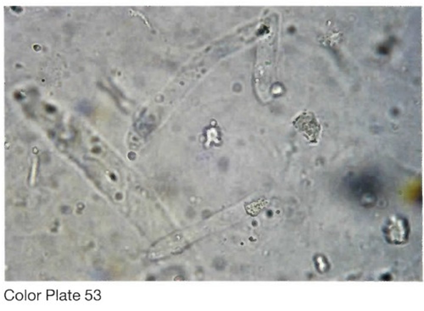 <p>A. As seen in Color Plate 53B, hyaline casts are</p><p>the most commonly observed cast, and they consist</p><p>completely of uromodulin (Tamm-Horsfall)</p><p>protein.</p>