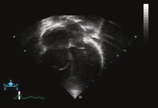 <p>19 yo M with easy fatiguability with exercise. O2 saturation is 86% with this echo.</p><p>What condition?</p>