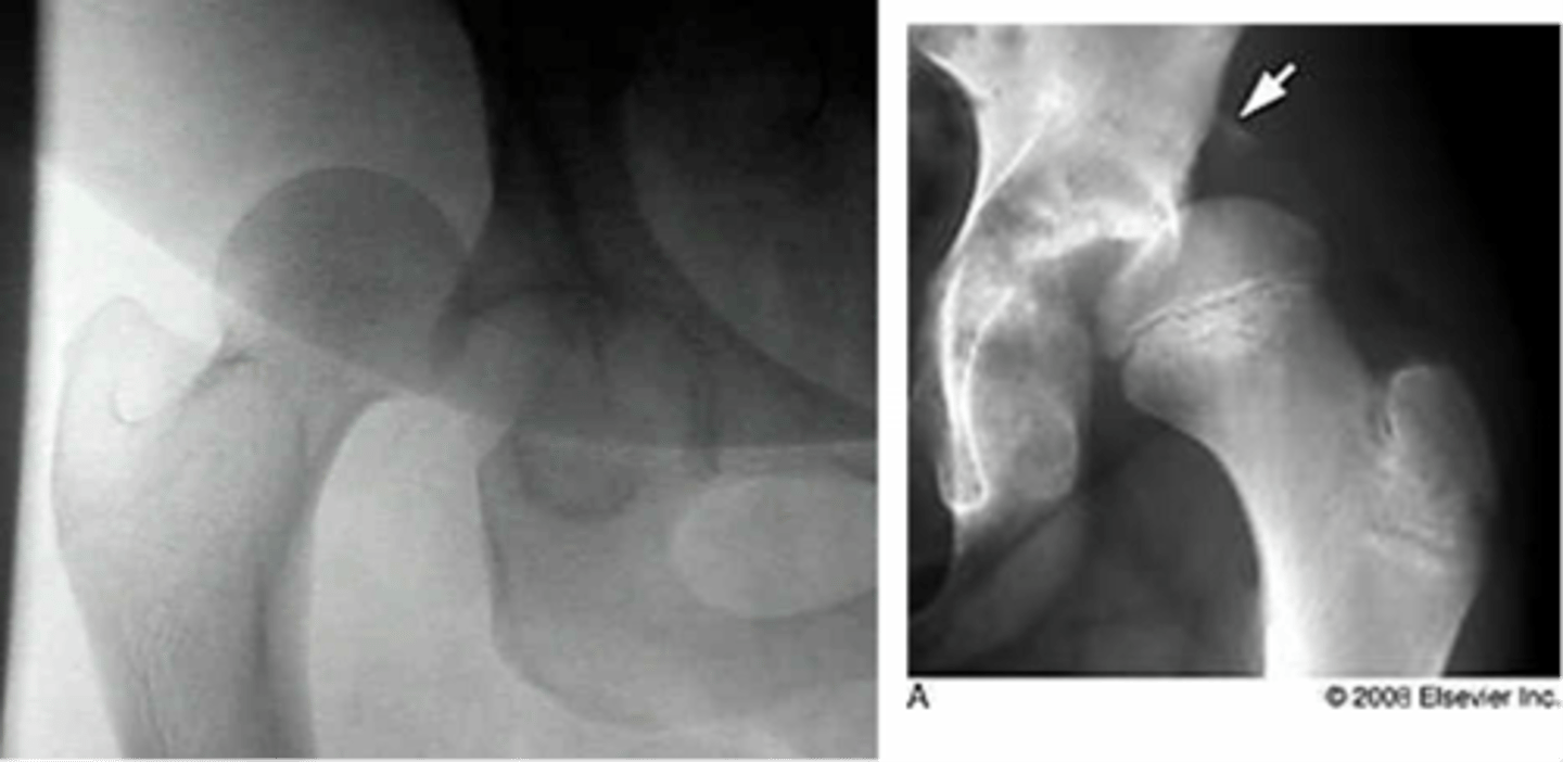 <p>causes by high force (generally MVA)</p><p>*usually occurs posterior when the leg is flexed, adducted and medially rotated (crossed legs in passenger seat of car)</p><p>STRUCTURES--&gt; tearing, overstretching of the joint capsule, labrum, and ligaments</p><p>FUNCTIONAL DEFICITS--&gt; pain, limited motion, through may be hypermobile and prone to redislocation due to weakened/damaged joint structures</p><p>COMPENSATORY MOVEMENTS--&gt; antalgic gait, muscle guarding around the joint</p>