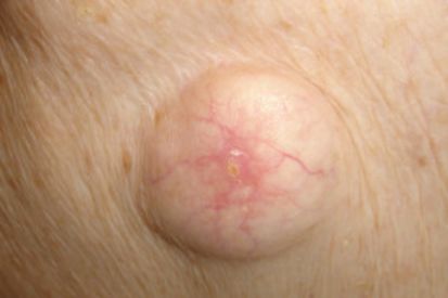 <p>A sac filled with fluid or semi solid material </p>
