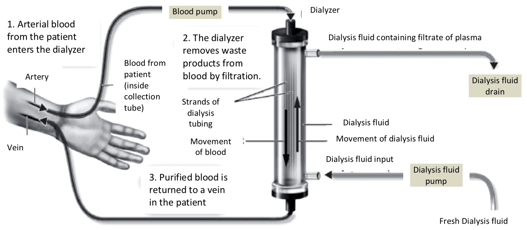 <p>A dialysis machine removes waste products and excess salts from the blood; this type of dialysis is called <strong>haemodialysis.</strong></p><p>Blood is taken from an artery in the arm (1) and is passed through thousands of long narrow strands of selectively permeable dialysis tubing. The fibres are surrounded by dialysis fluid.</p><p>Heparin prevents blood clotting in the dialysis machine. Machine includes a trap for air bubbles.</p><p>Waste products pass out of the blood plasma, through the pores in the dialysis tubing, into the dialysis fluid (2).</p><p>The fluid flows in the opposite direction to the blood (counter-current flow) and is continuously replaced to maintain steep concentration gradients.</p><p>Clean blood is returned to the patient through a vein (3). This type of dialysis is carried out three days a week, with each session lasting four hours.</p>