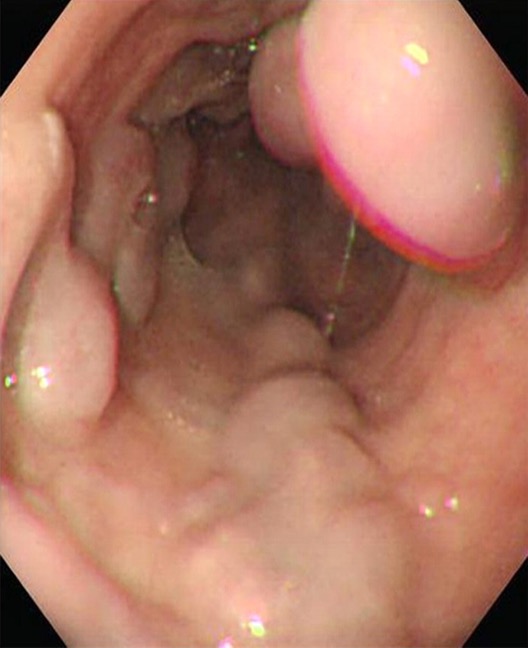 <p>What are enlarged venous collateral channels that dilate as a result of <strong>portal HTN, </strong>and has highest mortality/morbidity of any UGI bleed<strong>?</strong></p>