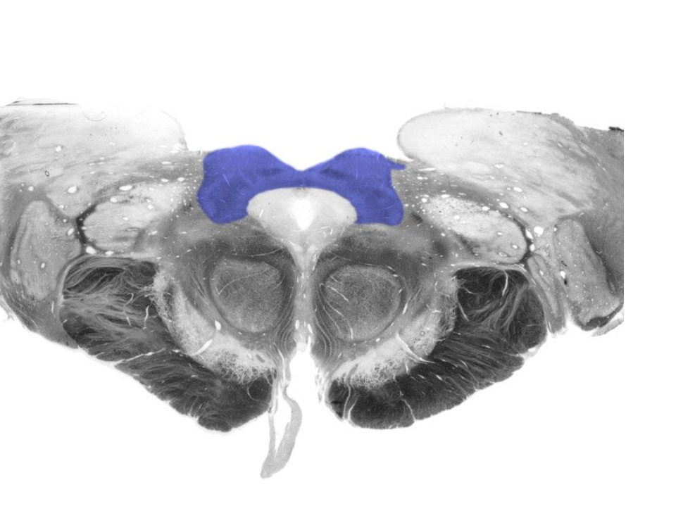 <p>Paired hillocks on the dorsal surface of the midbrain overlying the cerebral aqueduct, which are involved in orienting movements of the head and eyes. Together with the inferior colliculi, these structures are also known as the "tectum" (which means roof) and the "quadrageminal bodies".</p>