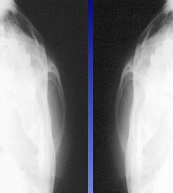 <p>What is this x-ray demonstrating?</p>