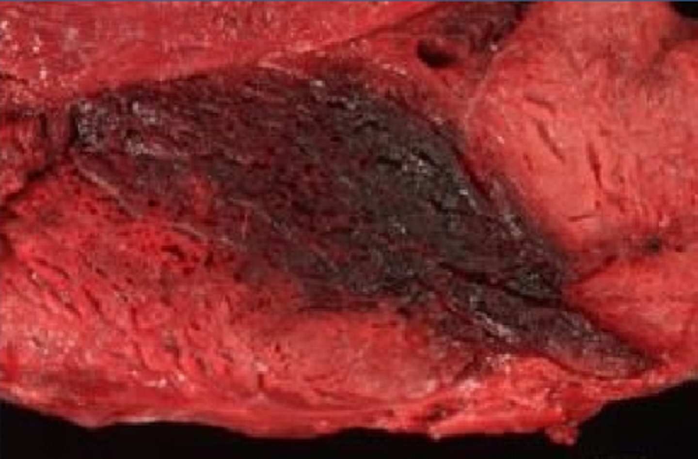 <p>infectieuze aandoening, vooral bij kalveren zit diep in de spieren</p><p>- toxine en gasproductie => necrose </p><p>- acute infectie die moeilijk te behandelen is </p><p>rund (soms ook rund, schaap, geit, bizon, hert ...)</p>