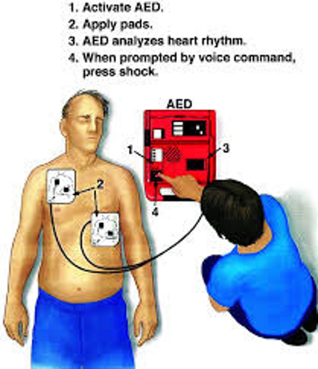 <p>- application of an electric shock to the myocardium through the chest wall to restore normal cardiac rhythm</p><p>- pads are placed on either side of the heart</p><p>- early defibrillation is best</p><p>- may use an automated external defibrillator (AED) or a defibrillator (in the hospital)</p>