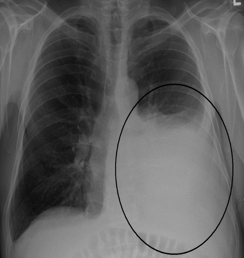 <p>Collection of fluid in the <strong>pleural cavity</strong></p>