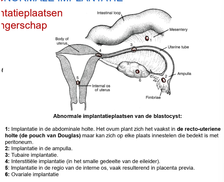 <p>= extra-uteriene zwangerschap</p>