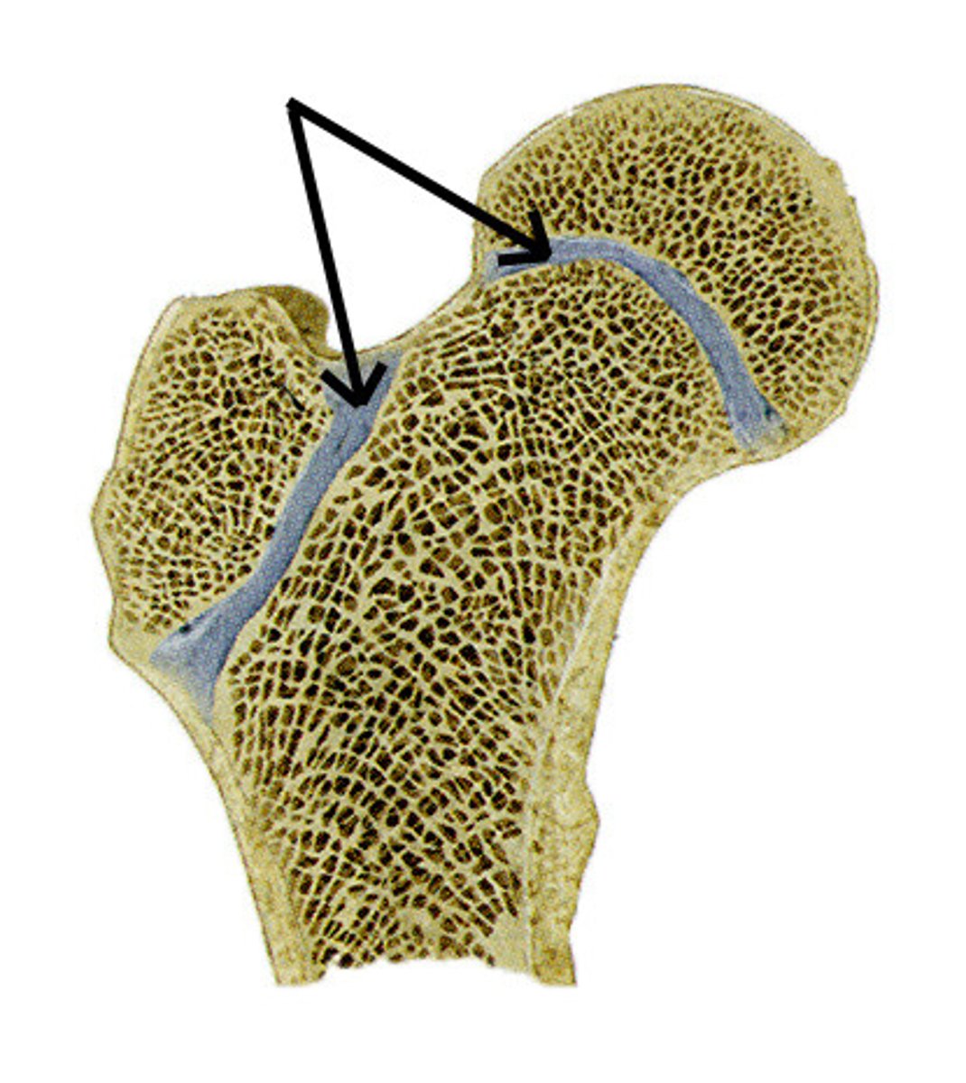 <p>between the epiphyses and diaphysis; remnant of childhood bone growth at epiphyseal plate</p>