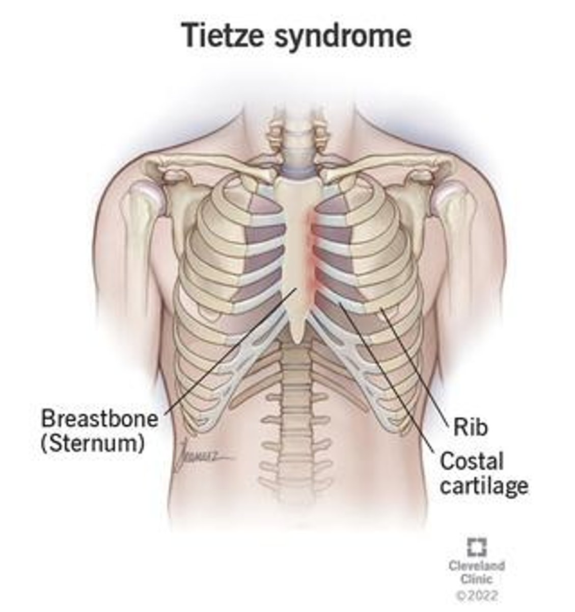 <p>A rare cause of musculoskeletal chest pain characterized by swelling and tenderness at the costochondral junction.</p>