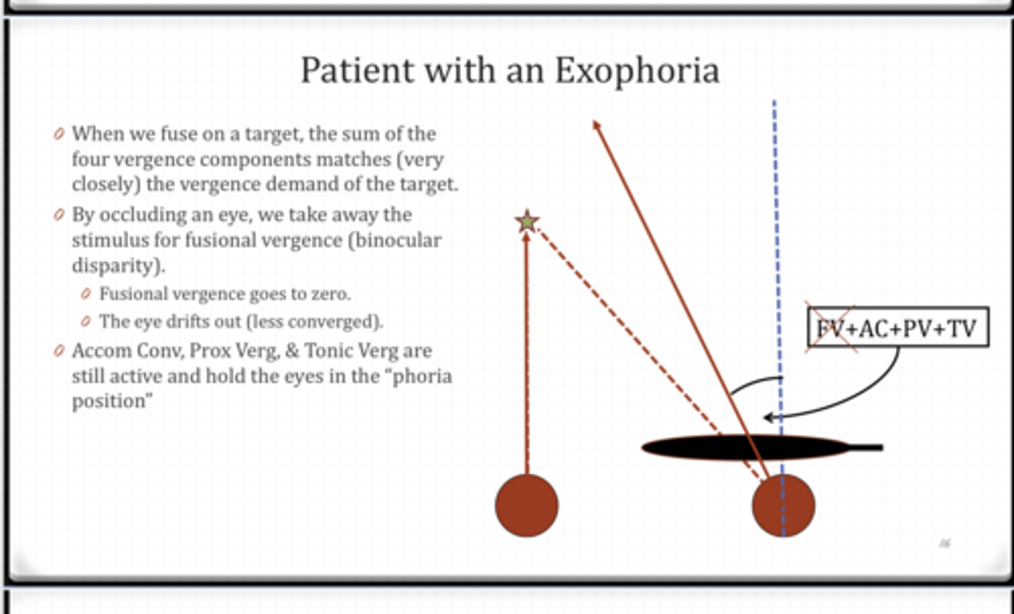 <p>Patient with an EXOphoria Example</p><p>If fusional vergence is 0, what is holding the eye in a phoric position?</p>