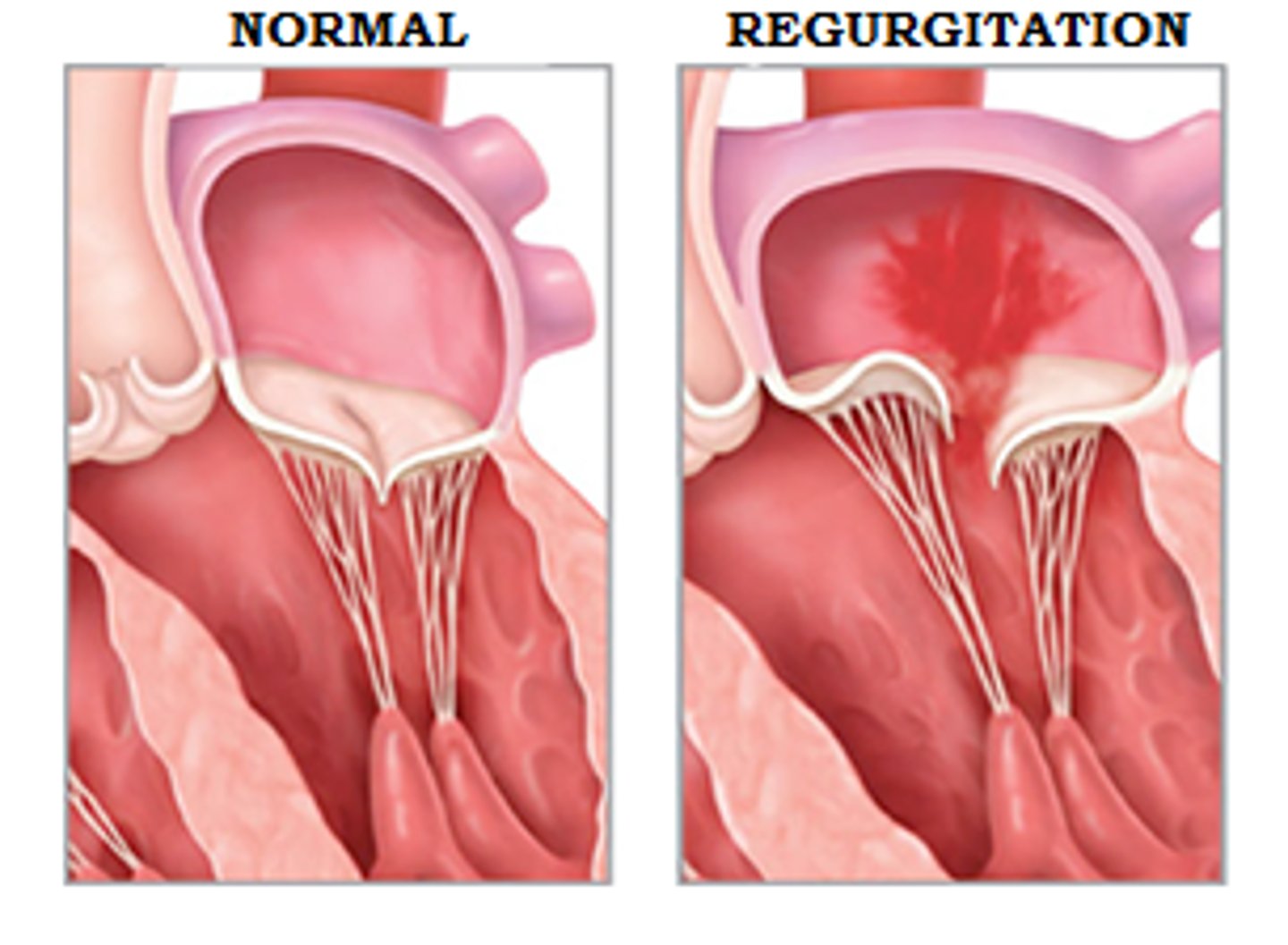 <p>- fail to shut completely</p><p>- increases blood volume/workload, leads to dilation and hypertrophy</p>