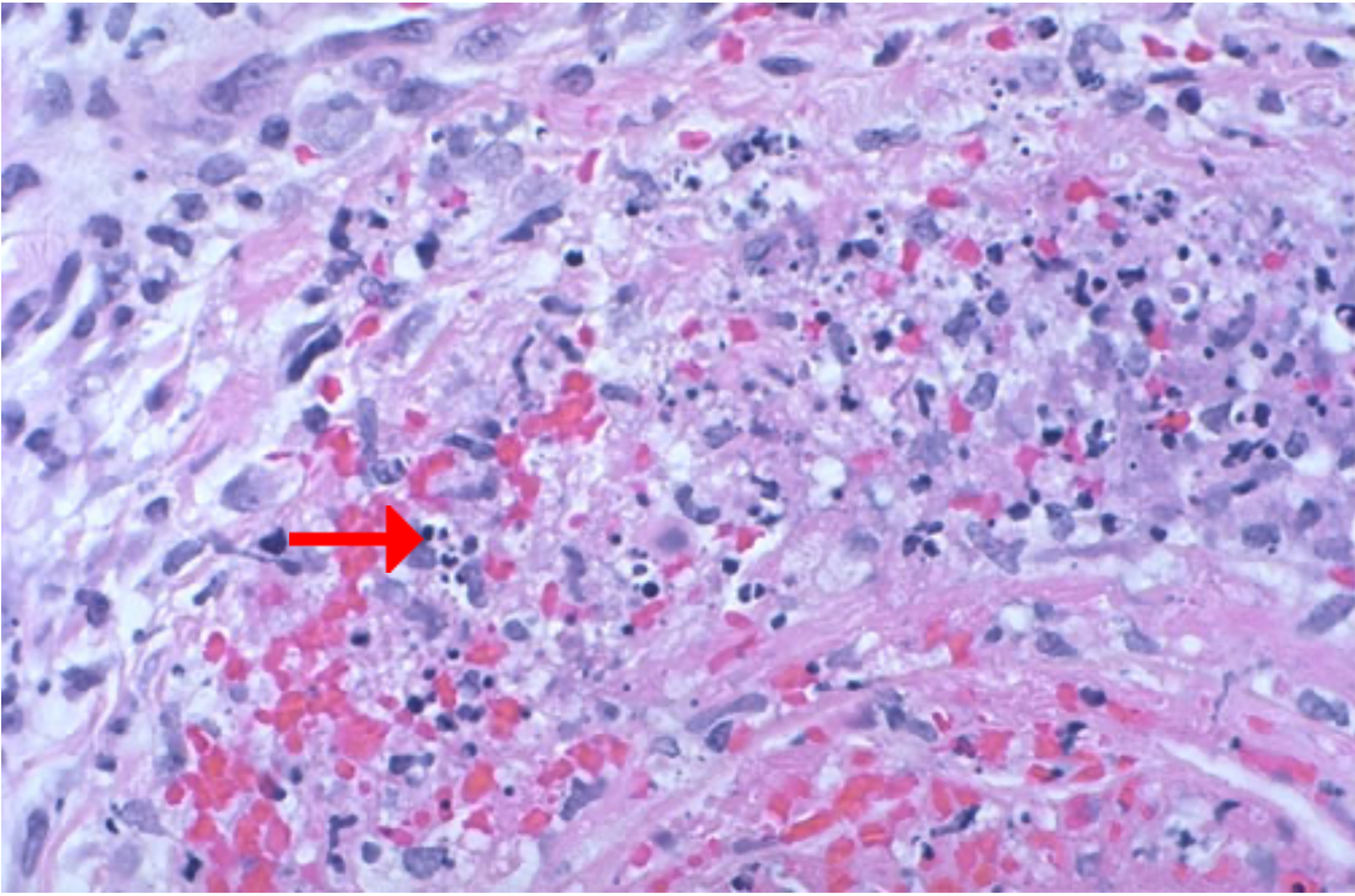 <ol><li><p>Identify pathology</p></li><li><p>What is seen here?</p></li></ol>