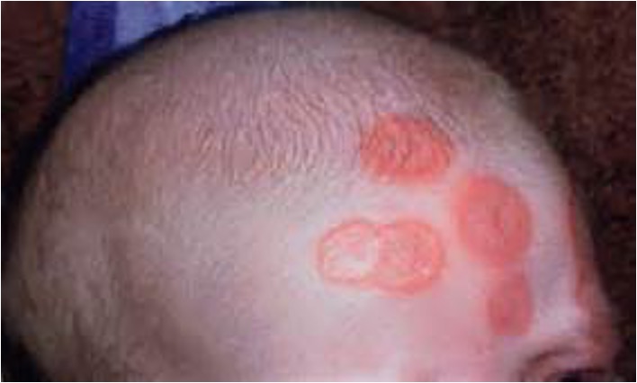 <p><strong>What condition is a clinical spectrum of cutaneous, cardiac, systemic abnormalities observed in newborn infants whose mothers have autoantibodies against RO/SSA and LA/SSB?</strong></p>