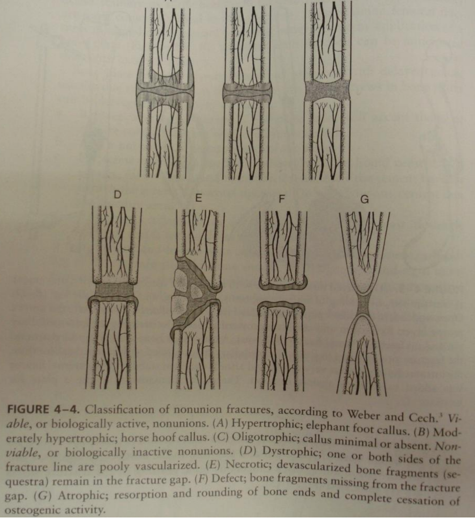 <p>Non-union fractures - categorizes non-unions based on their bio activity and characteristics of fracture site. </p><ol><li><p><strong>viable (biologically active)</strong></p><ul><li><p>hypertrophic - “elephant foot” callus</p></li><li><p>moderately hypertrophic - “horse hoof” callus </p></li><li><p>oligotrophic - minimal/absent callus</p></li></ul></li><li><p><strong>non-viable (biologically inactive) </strong></p><ul><li><p>dystrophic - poorly vascularized bone fragments remain in fracture gap</p></li><li><p>necrotic - devascularized bone fragments present</p></li><li><p>atrophic - resoprtion + rounding of bone ends - severe lack of healing</p></li></ul></li></ol><p></p>