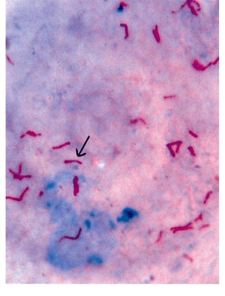 Mycobacterium tuberculosis