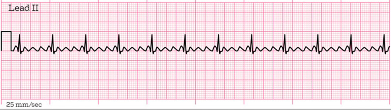 <p>What does this EKG represent?</p>
