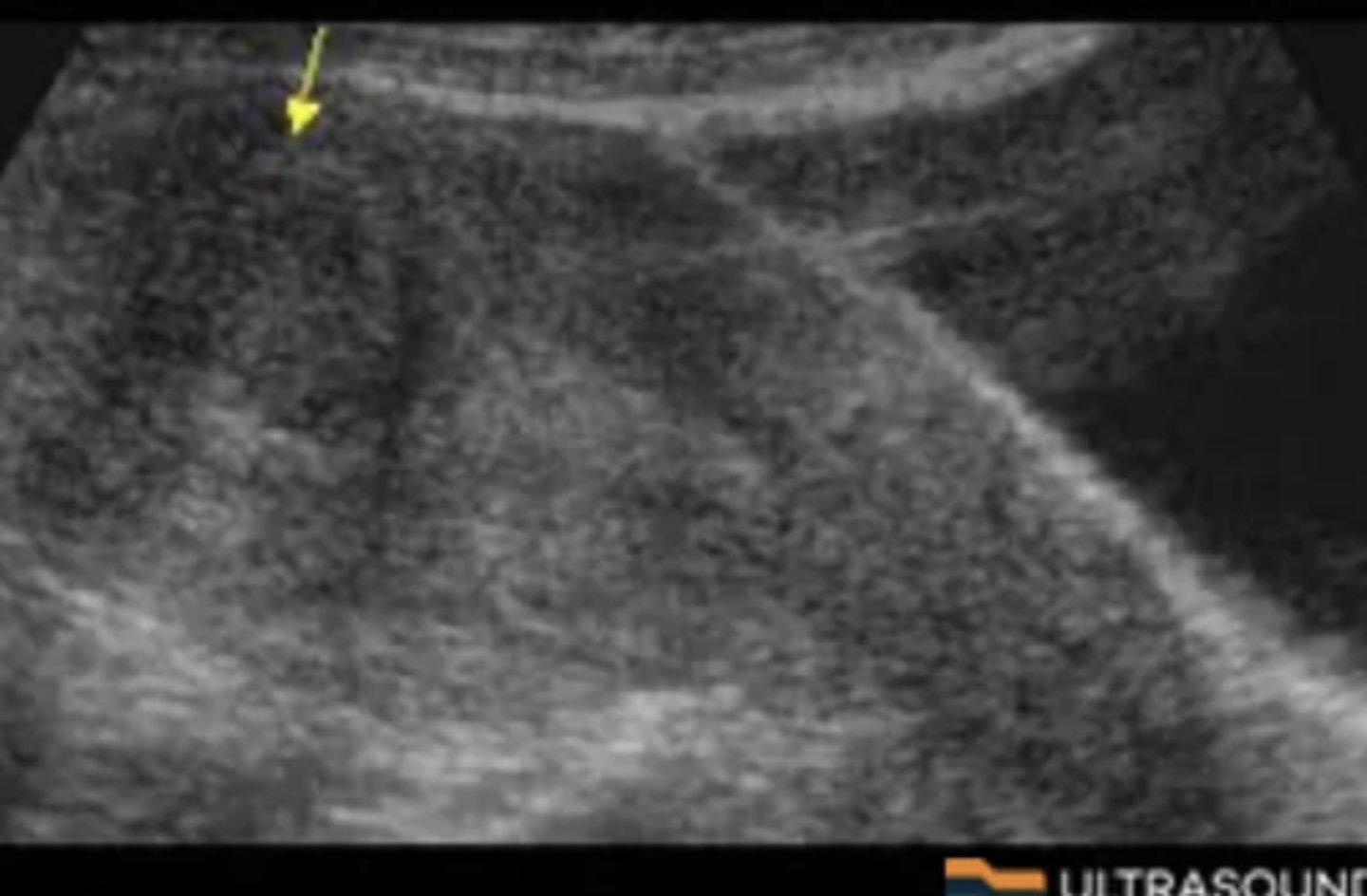 <p>Submucosal</p><p>-The fibroid indents or distorts the contour of the endometrium=submucosal</p>