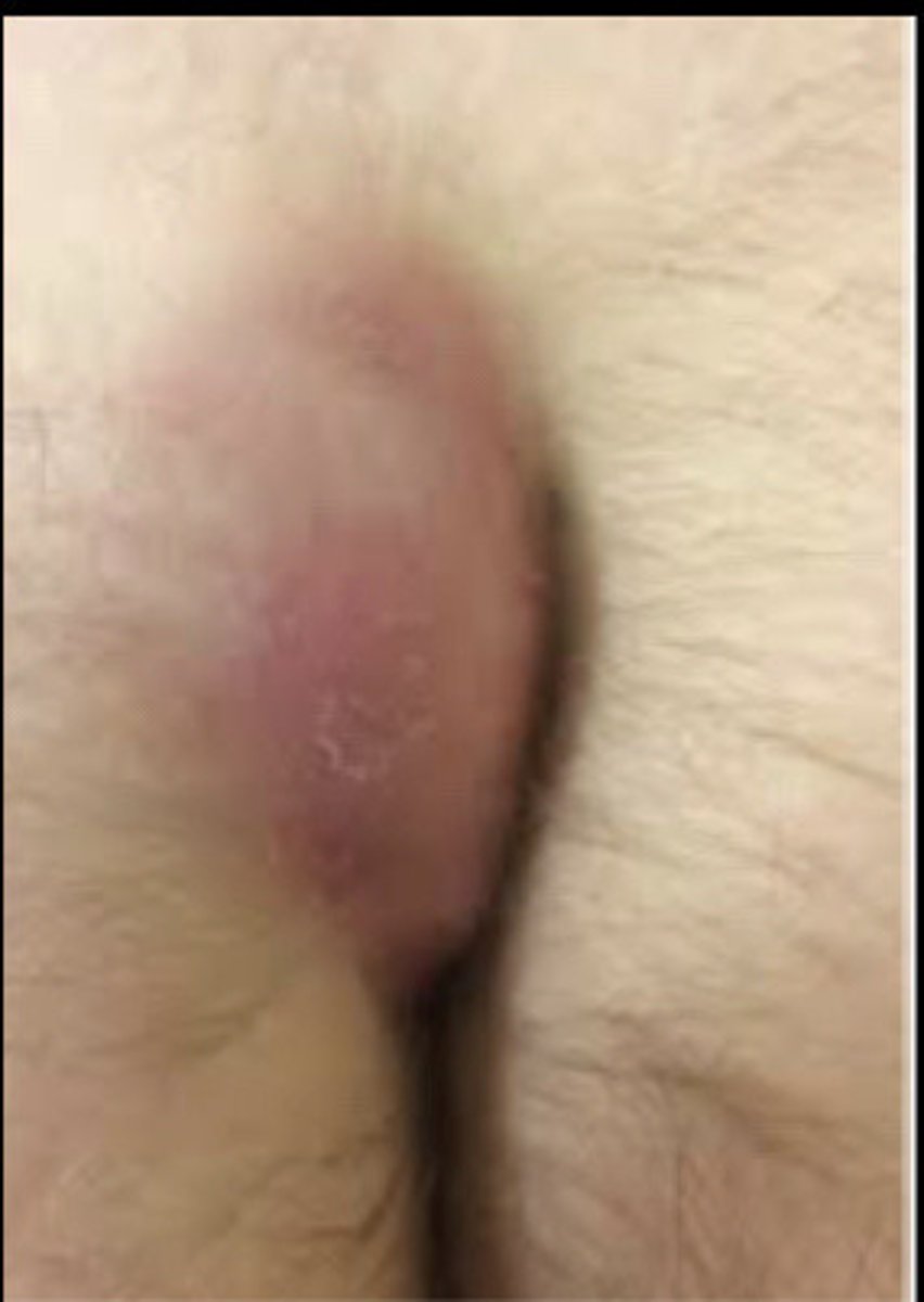 <p>1) No treatment if asymptomatic <br><br>2) I &amp; D, excision of abscess <br><br>3) refer to gen surgery <br><br>4) Pain Management/ oral antibiotics</p>