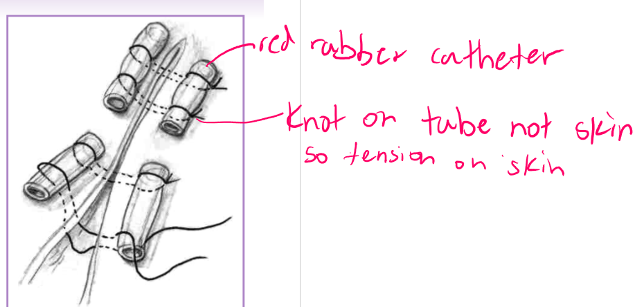 <ul><li><p>cruciate </p></li><li><p>horizontal mattress </p></li><li><p>vertical mattress </p></li><li><p>far-near-near-far </p></li><li><p>help prevent sutures from cutting out </p></li><li><p>provides <strong>limited </strong>tension relief </p></li><li><p>can place sutures farther from skin edge or use suture pattern to help disperse pressure </p><ul><li><p>cruciate - in skin </p></li><li><p>horizontal / vertical mattress - in fascia/deep tissue </p></li><li><p>far-near-near-far </p></li></ul></li><li><p>stents and quills </p></li><li><p>skin stretching </p></li></ul><p></p>