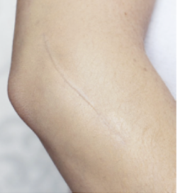 <p><strong>scar 6month-1 year that is narrow, flat, pale/hypo-pigmented</strong></p>