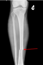 <p>What is the plane of this fracture? </p>