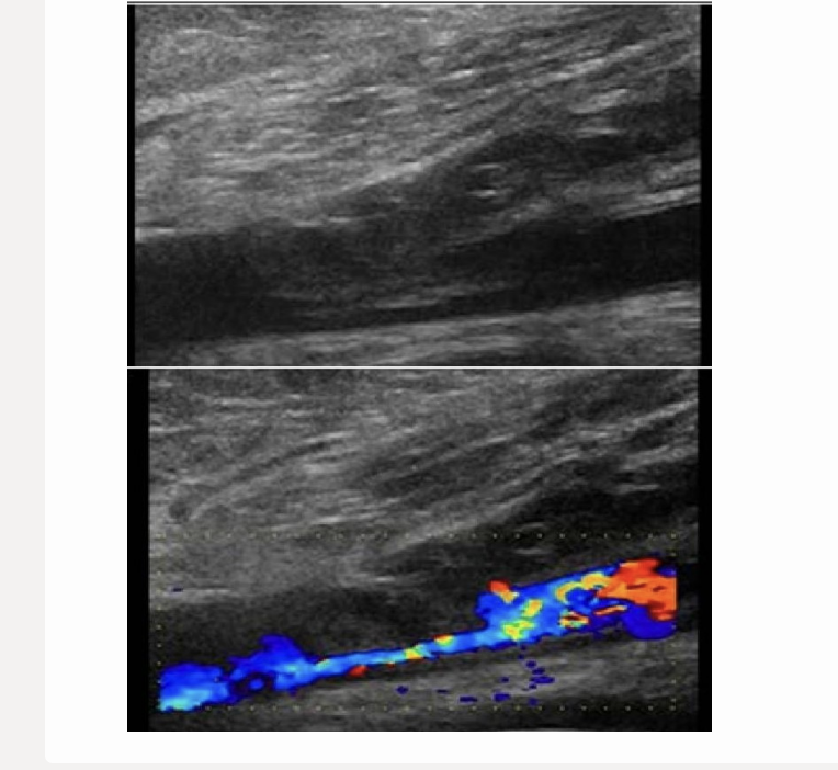 <p>a) tumor invasion</p><p>b) embolism formation</p><p>c) soft plaque formation </p><p>d) thrombus formation</p>