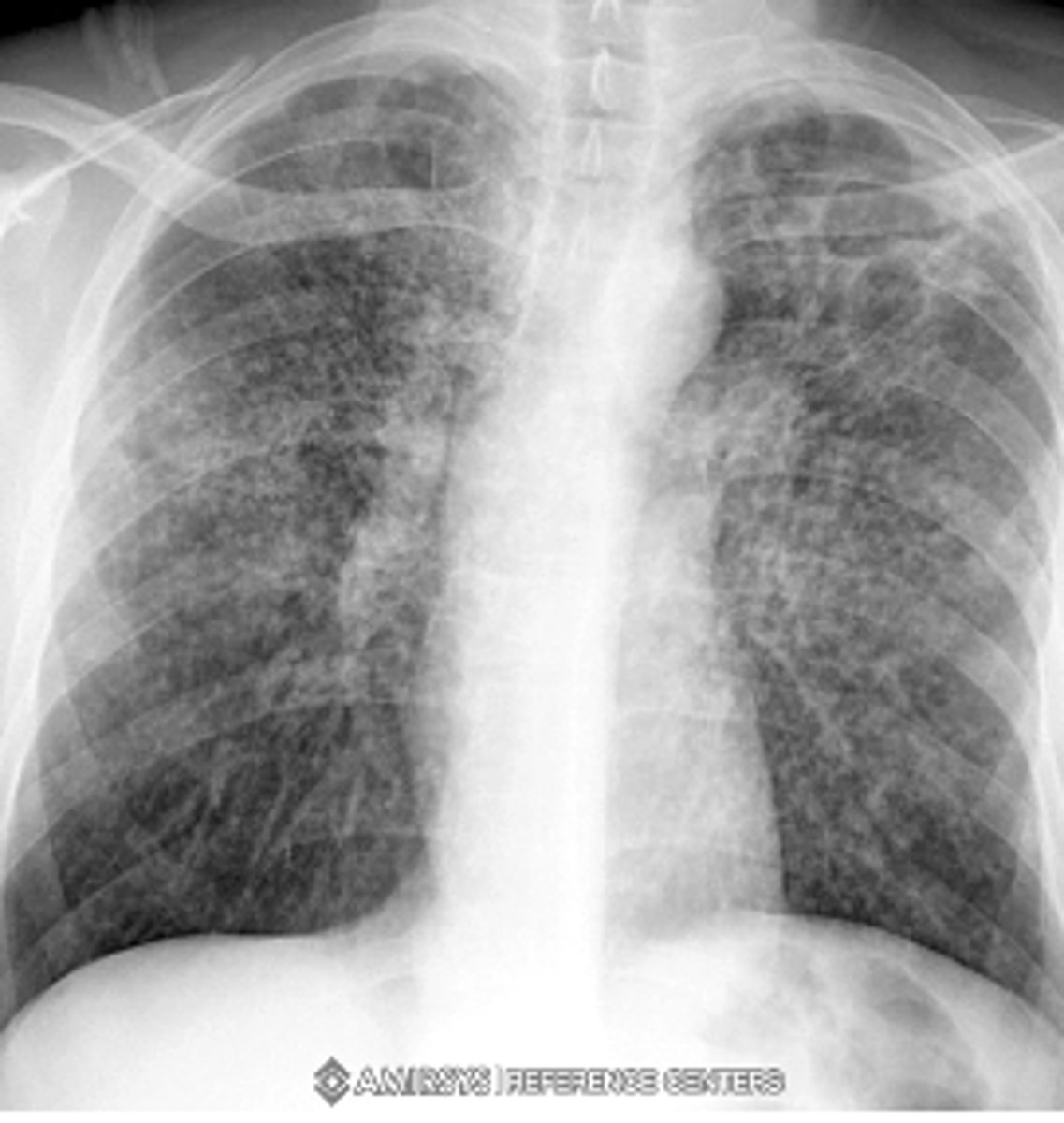 <p>oEnlargement of hilar or mediastinal lymph nodes is present about 95% of the time in primary active TB.</p><p>oCalcification usually occurs at the site of infection or in the node or both.</p>