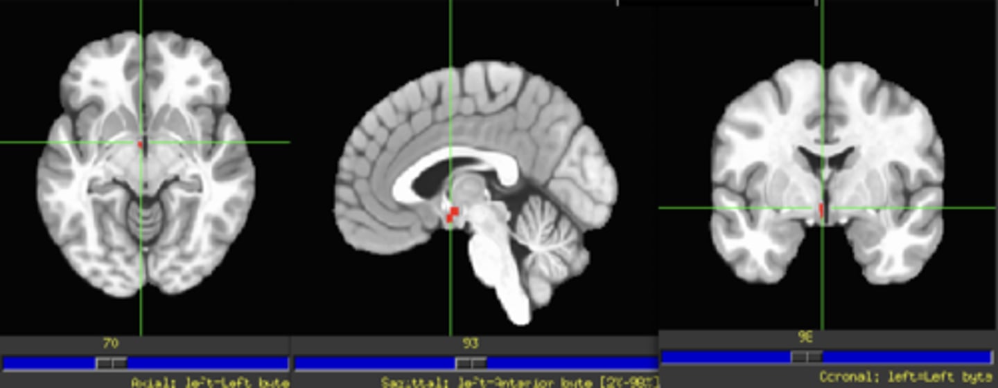 <p>- part of the diencephalon</p>