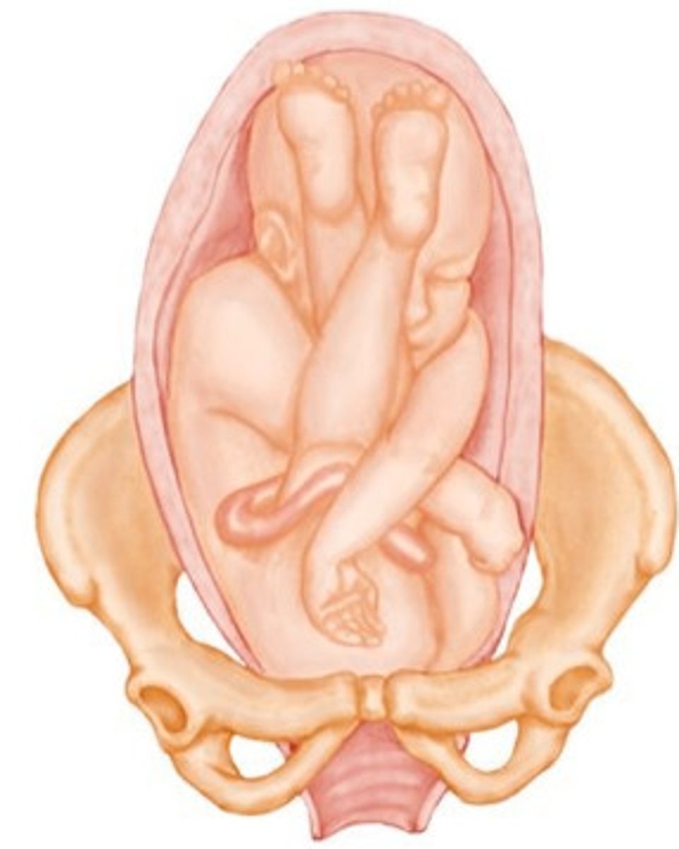 <p>butt is down, coming out first</p>