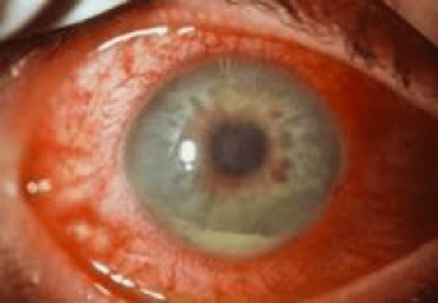 <p><u>Etio</u>: uvea is vascular middle layer of eye, inflamed, hypopyon: leukocytic exudate in ant. chamber</p><p><u>S&amp;S</u>: <strong>Anterior</strong>: eye pain, marked photophobia, blurred vision, red eye, <strong><mark data-color="#f7ff00" style="background-color: #f7ff00; color: inherit">myosis</mark></strong></p><p><strong>Posterior</strong>: only with <strong>blurred vision</strong> and red eye</p><p><u>Tx</u>: <strong><mark data-color="#fff500" style="background-color: #fff500; color: inherit">tx based on the cause</mark> **LOTS of conditions associated with this, </strong>emergent referral to optho </p>