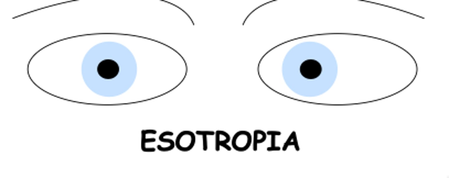 <p>one or both eyes turn inward</p>