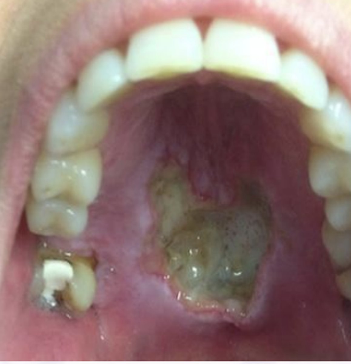 <p>Necrotizing Sialometaplasia</p>